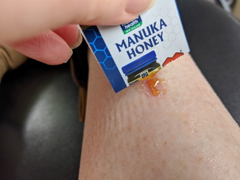 Does Manuka Honey Really Heal Wounds And Rashes?